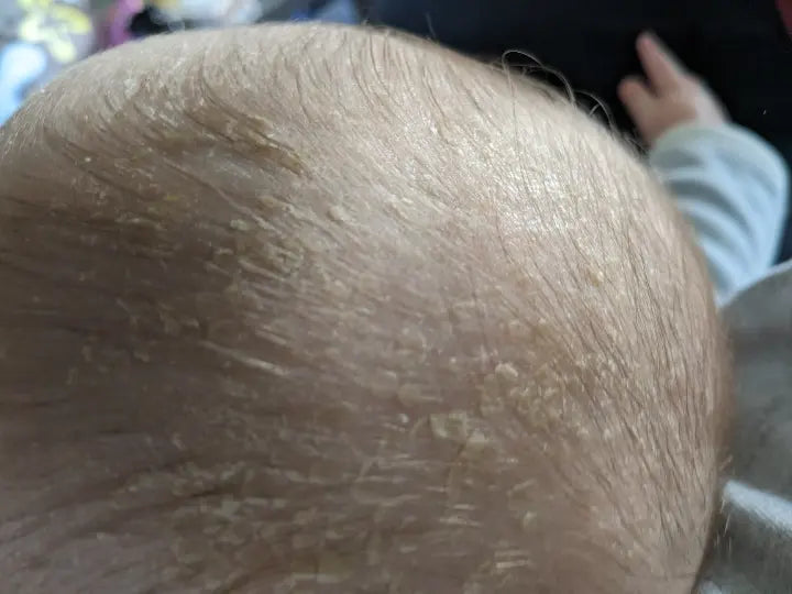 Sag Milchschorf adé: Der umfassende Leitfaden für besorgte Eltern!