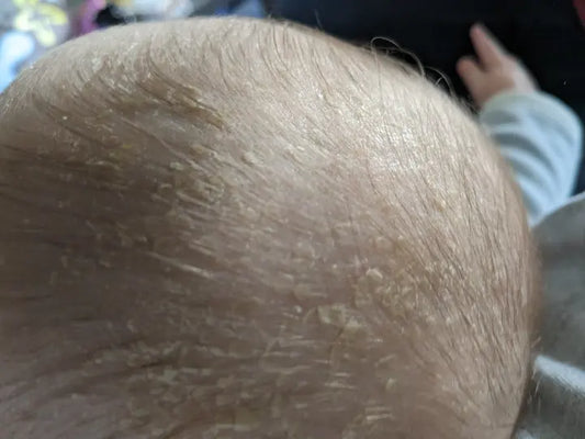 Sag Milchschorf adé: Der umfassende Leitfaden für besorgte Eltern!