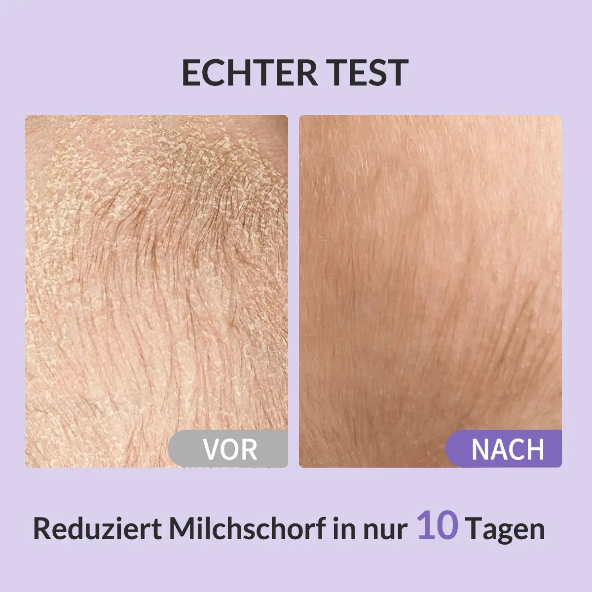 Vergleich: Deutlich gelöster und reduzierter Milchschorf nach der Anwendung des Shampoos.