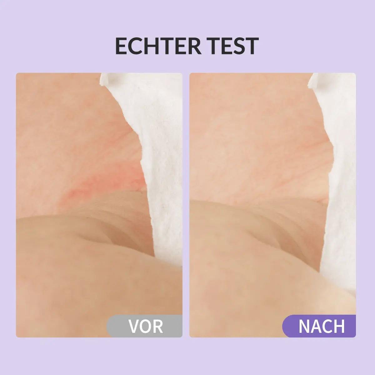 Die beruhigende und heilende Wirkung der Zinkcreme bei ersten Anzeichen von Windeldermatitis (Rötungen).