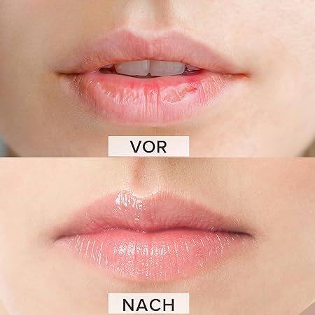 Die regenerierende Wirkung des SOS-Balsams: Deutlich geglättete und beruhigte Haut nach der Anwendung bei lokaler Trockenheit.